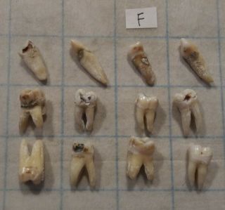 12 Vintage Real Human Teeth.  Inv F