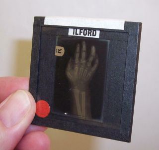 Vintage Medical Slide Hand X - Ray Skeleton Royal Alexandra Hospital