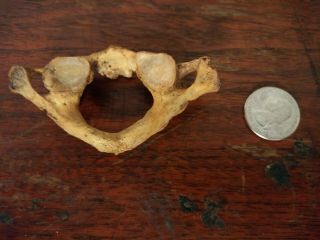 Real Human Neck Bone Vertebrae Antique Medical Specimen