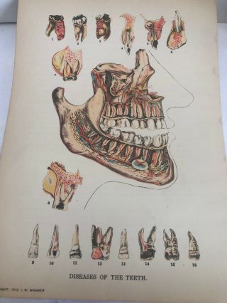 1912 Medical Dental Diseases Of The Teeth Illustration I.  W.  Wagner