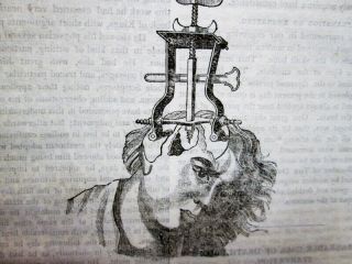 1832,  Antique Medical ; Skull Trauma - Trepanning Trephining